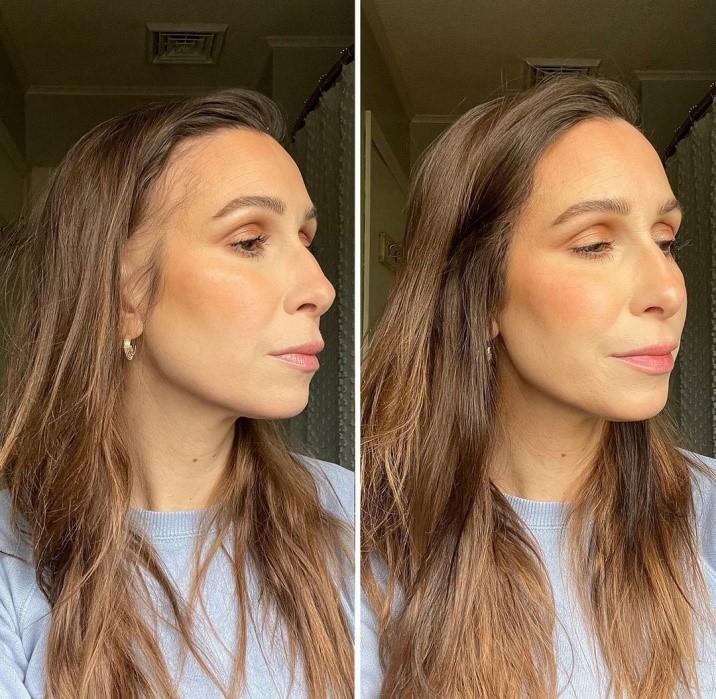 Best Hair Patches For Frontal Fibrosing Alopecia